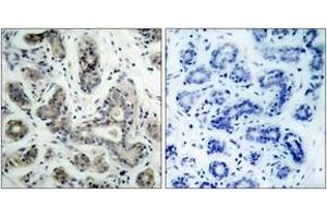 Immunohistochemistry analysis of paraffin-embedded human breast carcinoma tissue, using PDK1 (Ab-241) Antibody. (PDPK1 Antikörper  (AA 210-259))