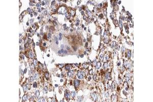 ABIN6266641 at 1/100 staining human lung carcinoma tissue sections by IHC-P. (TGFB2 Antikörper  (C-Term))