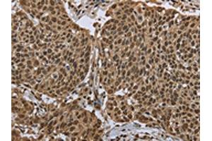The image on the left is immunohistochemistry of paraffin-embedded Human cervical cancer tissue using ABIN7130674(PPAT Antibody) at dilution 1/50, on the right is treated with fusion protein.