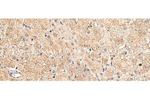 Immunohistochemistry of paraffin-embedded Human liver cancer tissue using LRG1 Polyclonal Antibody at dilution of 1:80(x200) (LRG1 Antikörper)