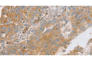 Immunohistochemistry of paraffin-embedded Human breast cancer using STX16 Polyclonal Antibody at dilution of 1:30 (Syntaxin 16 Antikörper)