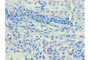 Immunohistochemistry of paraffin-embedded human breast cancer using ABIN7155327 at dilution of 1:100 (HDAC8 Antikörper  (AA 1-377))