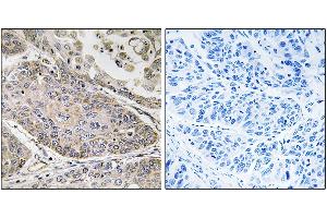 Immunohistochemistry analysis of paraffin-embedded human lung carcinoma tissue using PLA2G4E antibody. (PLA2G4E Antikörper)