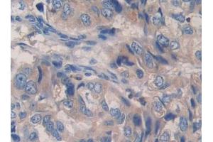 Used in DAB staining on fromalin fixed paraffin- embedded liver cancer tissue
