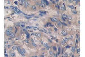 Used in DAB staining on fromalin fixed paraffin- embedded liver cancer tissue (PCSK9 Antikörper  (AA 454-679))