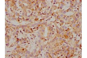 IHC image of ABIN7127380 diluted at 1:118 and staining in paraffin-embedded human liver cancer performed on a Leica BondTM system. (Rekombinanter CA9 Antikörper)