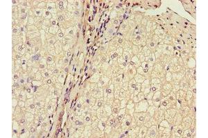 Immunohistochemistry of paraffin-embedded human liver cancer using ABIN7159937 at dilution of 1:100 (BRP44 Antikörper  (AA 1-40))