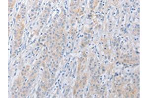 The image on the left is immunohistochemistry of paraffin-embedded Human gastric cancer tissue using ABIN7131038(SERPINE2 Antibody) at dilution 1/20, on the right is treated with fusion protein. (SERPINE2 Antikörper)