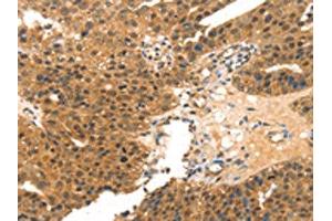 The image on the left is immunohistochemistry of paraffin-embedded Human breast cancer tissue using ABIN7191443(MED14 Antibody) at dilution 1/20, on the right is treated with synthetic peptide. (MED14 Antikörper)