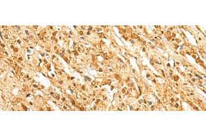 Immunohistochemistry of paraffin-embedded Human prost ate cancer tissue using SSSCA1 Polyclonal Antibody at dilution of 1:50(x200)