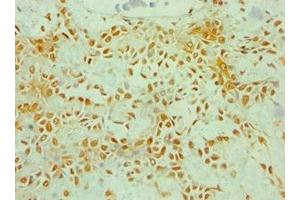 Immunohistochemistry of paraffin-embedded human breast cancer using ABIN7176253 at dilution of 1:100