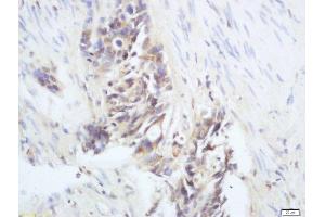Formalin-fixed and paraffin embedded human colon cancer labeled with Anti-phospho-RAC1(Ser71) Polyclonal Antibody, Unconjugated  at 1:200 followed by conjugation to the secondary antibody and DAB staining (RAC1 Antikörper  (pSer71))