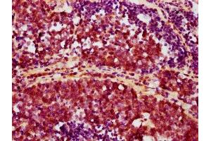 IHC image of ABIN7127677 diluted at 1:100 and staining in paraffin-embedded human lung cancer performed on a Leica BondTM system. (Rekombinanter AKT1 Antikörper  (pSer473))