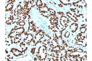 IHC testing of FFPE human prostate carcinoma with FOXA1 antibody (clone FOXA1/1518). (FOXA1 Antikörper  (AA 372-472))