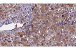 ABIN6276936 at 1/100 staining Human liver cancer tissue by IHC-P. (ABCG8 Antikörper  (Internal Region))