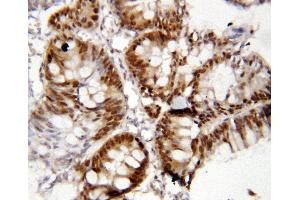 Anti-FOXP1 antibody, IHC(P) IHC(P): Human Rectal Cancer Tissue (FOXP1 Antikörper  (C-Term))