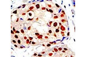 IHC analysis of FFPE human breast carcinoma tissue stained with the PRMT1 antibody (PRMT1 Antikörper  (AA 316-347))