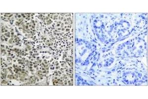 Immunohistochemistry analysis of paraffin-embedded human prostate carcinoma tissue, using Androgen Receptor (Ab-650) Antibody. (Androgen Receptor Antikörper  (AA 621-670))