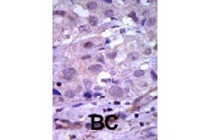 Formalin-fixed and paraffin-embedded human cancer tissue reacted with RET polyclonal antibody  , which was peroxidase-conjugated to the secondary antibody, followed by AEC staining.