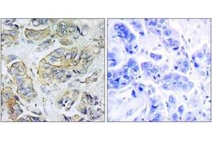 Immunohistochemistry analysis of paraffin-embedded human breast carcinoma tissue, using NPY5R Antibody. (NPY5R Antikörper  (AA 221-270))