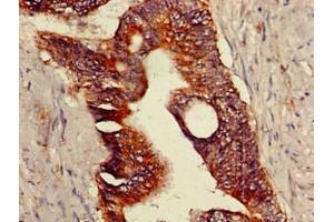 Immunohistochemistry of paraffin-embedded human colon cancer using ABIN7172875 at dilution of 1:100 (TRPV1 Antikörper  (AA 1-155))