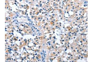 The image on the left is immunohistochemistry of paraffin-embedded Human thyroid cancer tissue using ABIN7128547(ASB2 Antibody) at dilution 1/50, on the right is treated with fusion protein. (ASB2 Antikörper)