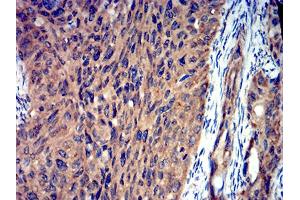 Immunohistochemical analysis of paraffin-embedded ROP1 tissues using cervical cancer mouse mAb with DAB staining.