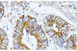 Immunohistochemistry of paraffin-embedded Human colon carcinoma using TRAP1 Polyclonal Antibody at dilution of 1:100 (40x lens). (TRAP1 Antikörper)
