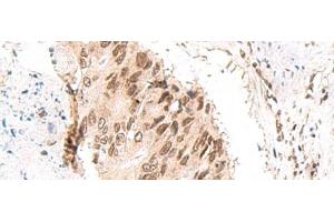 Immunohistochemistry of paraffin-embedded Human colorectal cancer tissue using CKMT1A/CKMT1B Polyclonal Antibody at dilution of 1:55(x200) (CKMT1 Antikörper)