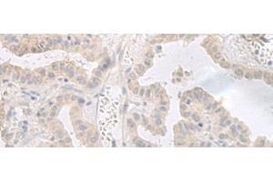 Immunohistochemistry of paraffin-embedded Human thyroid cancer tissue using GPRASP2 Polyclonal Antibody at dilution of 1:35(x200) (GPRASP2 Antikörper)