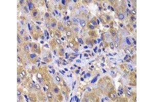 Immunohistochemistry of paraffin-embedded Human liver damage using CARD10 Polyclonal Antibody at dilution of 1:100 (40x lens). (CARD10 Antikörper)