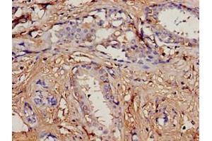 Immunohistochemistry analysis of human breast cancer using ABIN7164734 at dilution of 1:100 (PIP Antikörper  (AA 29-146))