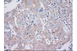 Immunohistochemical staining of paraffin-embedded Carcinoma of liver tissue using anti-KRT19mouse monoclonal antibody. (Cytokeratin 19 Antikörper  (AA 240-390))