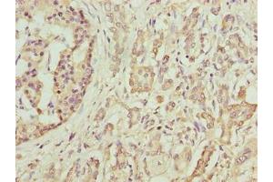 Immunohistochemistry of paraffin-embedded human pancreatic cancer using ABIN7145484 at dilution of 1:100 (DEFB129 Antikörper  (AA 20-183))