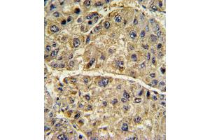 Formalin-fixed and paraffin-embedded human hepatocarcinoma with COL6A1 Antibody (N-term), which was peroxidase-conjugated to the secondary antibody, followed by DAB staining. (COL6A1 Antikörper  (N-Term))