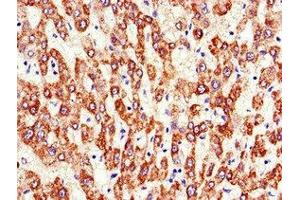 Immunohistochemistry of paraffin-embedded human liver cancer using ABIN7144836 at dilution of 1:100 (ATP5F1A (AA 59-257) Antikörper)