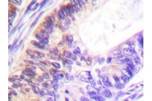Immunohistochemistry analyzes of Rsk-1 antibody in paraffin-embedded human colon carcinoma tissue. (RPS6KA1 Antikörper)