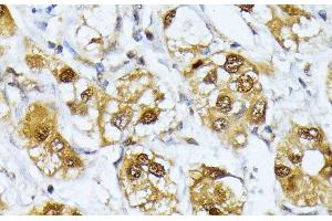 Immunohistochemistry of paraffin-embedded Human liver cancer using RRAGD Polyclonal Antibody at dilution of 1:100 (40x lens). (RRAGD Antikörper)