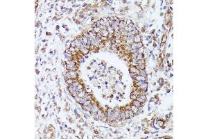 Immunohistochemistry of paraffin-embedded human colon carcinoma using DLAT antibody (ABIN7266768) at dilution of 1:100 (40x lens). (DLAT Antikörper  (AA 87-270))