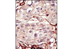 Formalin-fixed and paraffin-embedded human cancer tissue reacted with the primary antibody, which was peroxidase-conjugated to the secondary antibody, followed by DAB staining. (Aurora Kinase B Antikörper  (AA 283-313))