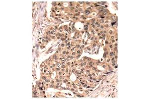 Immunohistochemistry of paraffin-embedded human breast carcinoma tissue, using Phospho-PXN-Y118 antibody (ABIN2987461). (Paxillin Antikörper  (pTyr118))