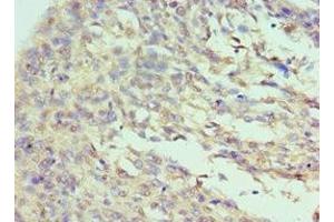 Immunohistochemistry of paraffin-embedded human cervical cancer using ABIN7156720 at dilution of 1:100 (Interleukin enhancer-binding factor 3 (ILF3) (AA 785-894) Antikörper)