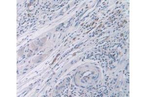 IHC-P analysis of Human Rectum Cancer Tissue, with DAB staining. (CDK2 Antikörper  (AA 94-198))