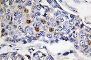 Immunohistochemistry (IHC) analyzes of POLR3A antibody in paraffin-embedded human breast carcinoma tissue. (POLR3A Antikörper)