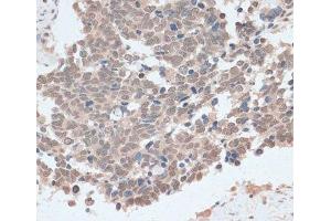 Immunohistochemistry of paraffin-embedded Human lung cancer using ZNF562 Polyclonal Antibody at dilution of 1:100 (40x lens). (ZNF562 Antikörper)