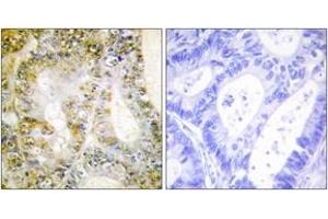 Immunohistochemistry analysis of paraffin-embedded human breast carcinoma tissue, using Catenin-beta1 Antibody. (CTNNB1 Antikörper  (AA 626-675))
