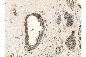 LAT2 Mouse Monoclonal Antibody at 1/100 staining human breast cancer by IHC-P.