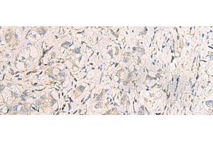 Immunohistochemistry of paraffin-embedded Human liver cancer tissue using SUSD3 Polyclonal Antibody at dilution of 1:95(x200) (SUSD3 Antikörper)