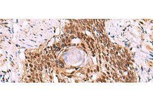 Immunohistochemistry of paraffin-embedded Human esophagus cancer tissue using LDB1 Polyclonal Antibody at dilution of 1:70(x200) (LIM Domain Binding 1 Protein Antikörper)