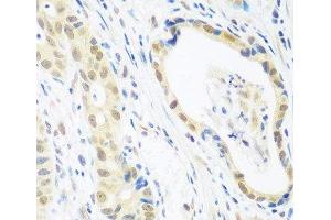 Immunohistochemistry of paraffin-embedded Human stomach cancer using POLR2E Polyclonal Antibody at dilution of 1:100 (40x lens). (POLR2E Antikörper)